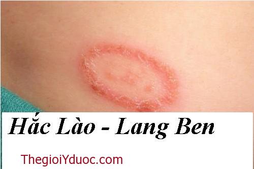 Thuốc chữa Hắc Lào và Lang Ben